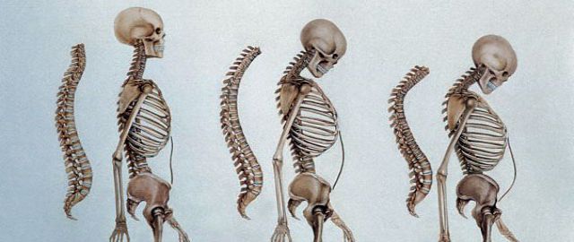 Osteoporosis and Menopause