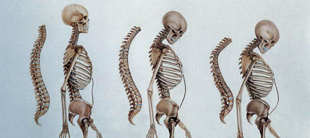 Osteoporosis and Menopause